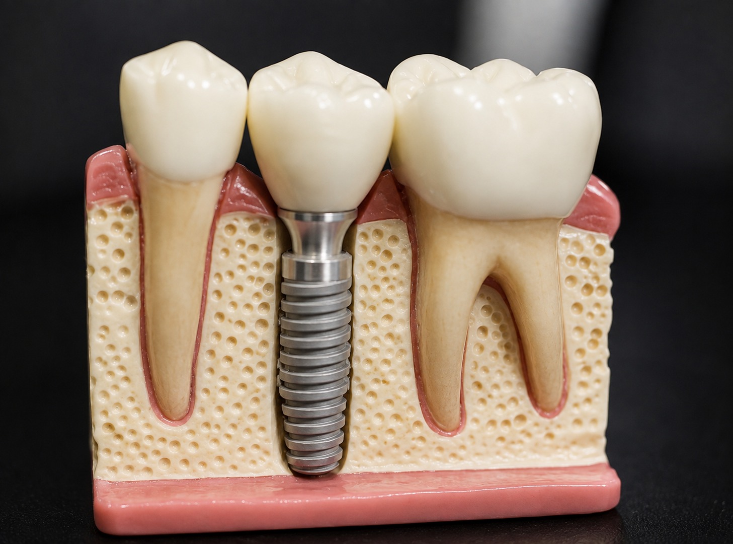 Implantat-Modell im Querschnitt: Zahnimplantat zwischen natürlichen Zähnen bei EDEL SMILE München Trudering