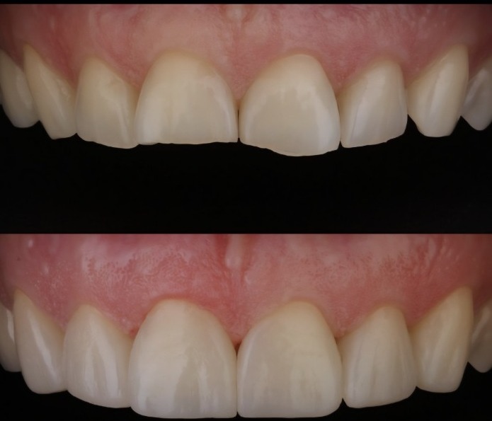 Injectable Composite vorher und nachher bei EDEL SMILE München Trudering
