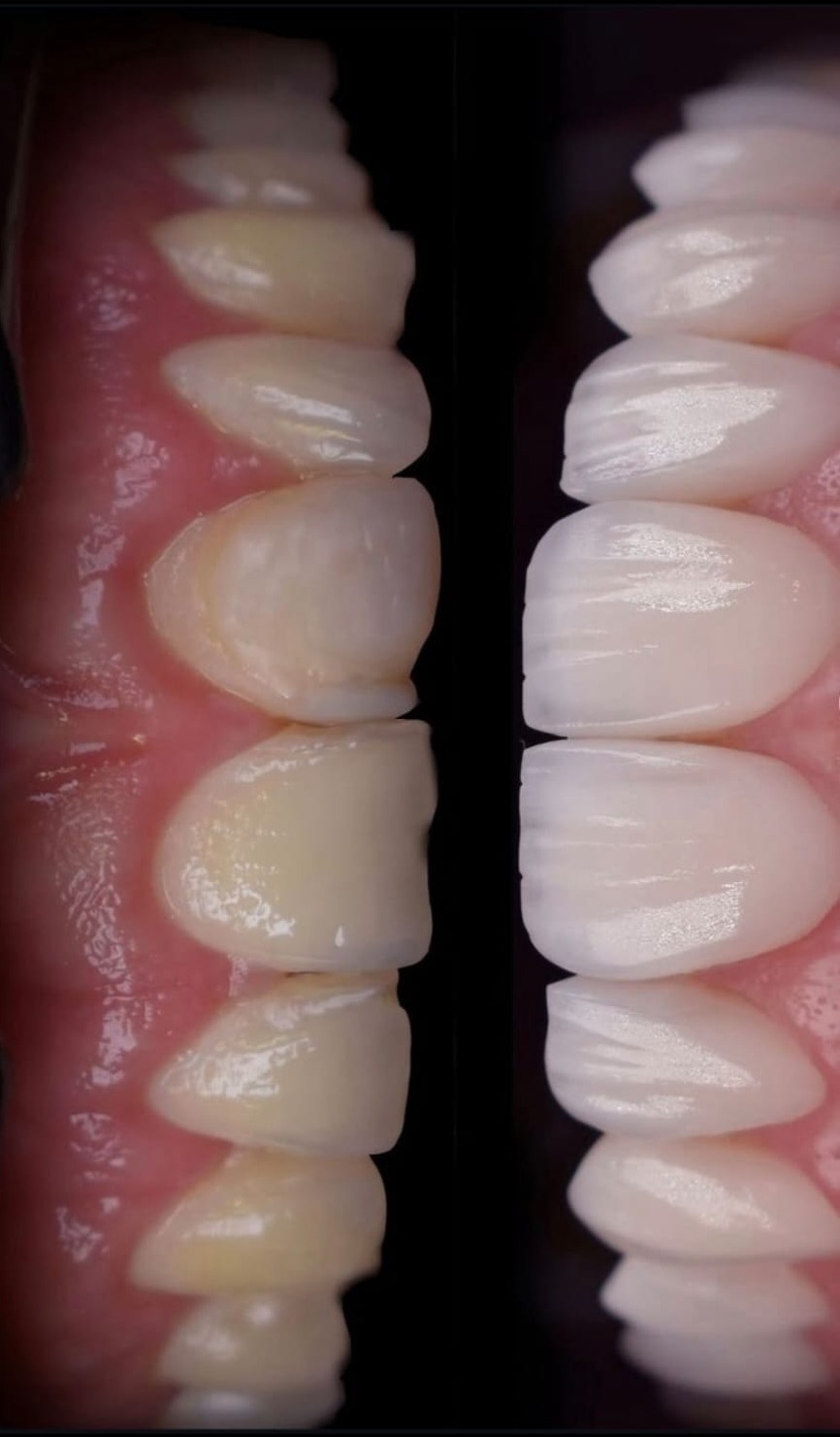 Nahaufnahme eines natürlichen Lächelns nach ästhetischer Behandlung bei EDEL SMILE München Trudering